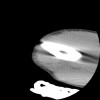 SPORK, NICO - 22.03.1976 - 02.08.2022 - CT obere Extremität - 17:51:17